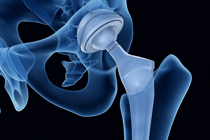 Everything You Need To Know About Direct Anterior Hip Replacements - Iowa  Ortho