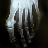 How Minimally Invasive Bunion Surgery (MIS) can change your life