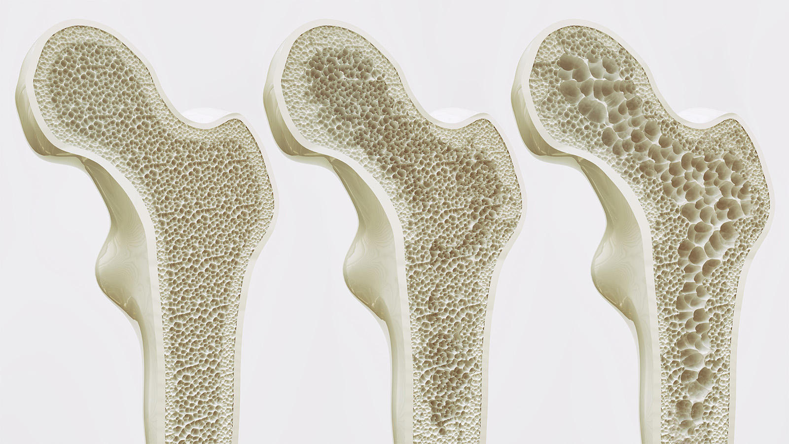 Why Your Bone Health Matters: Diagnosis is the First Step