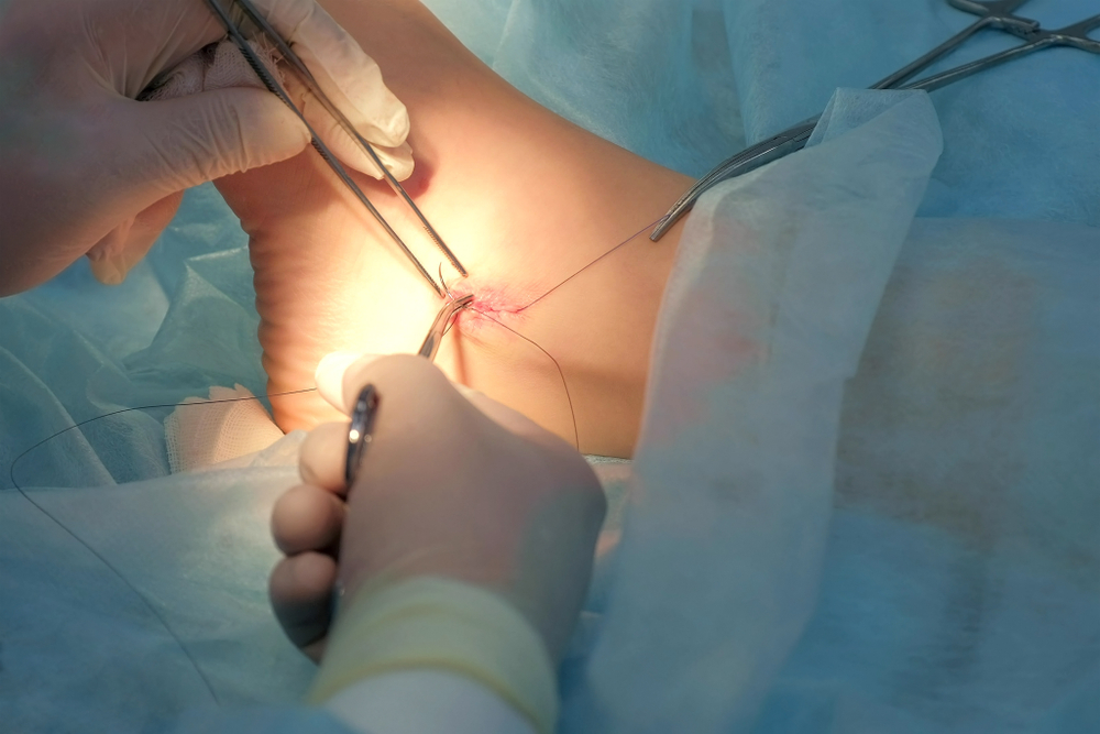 Orthopedic surgeon performing total ankle replacement to restore mobility and reduce ankle pain.