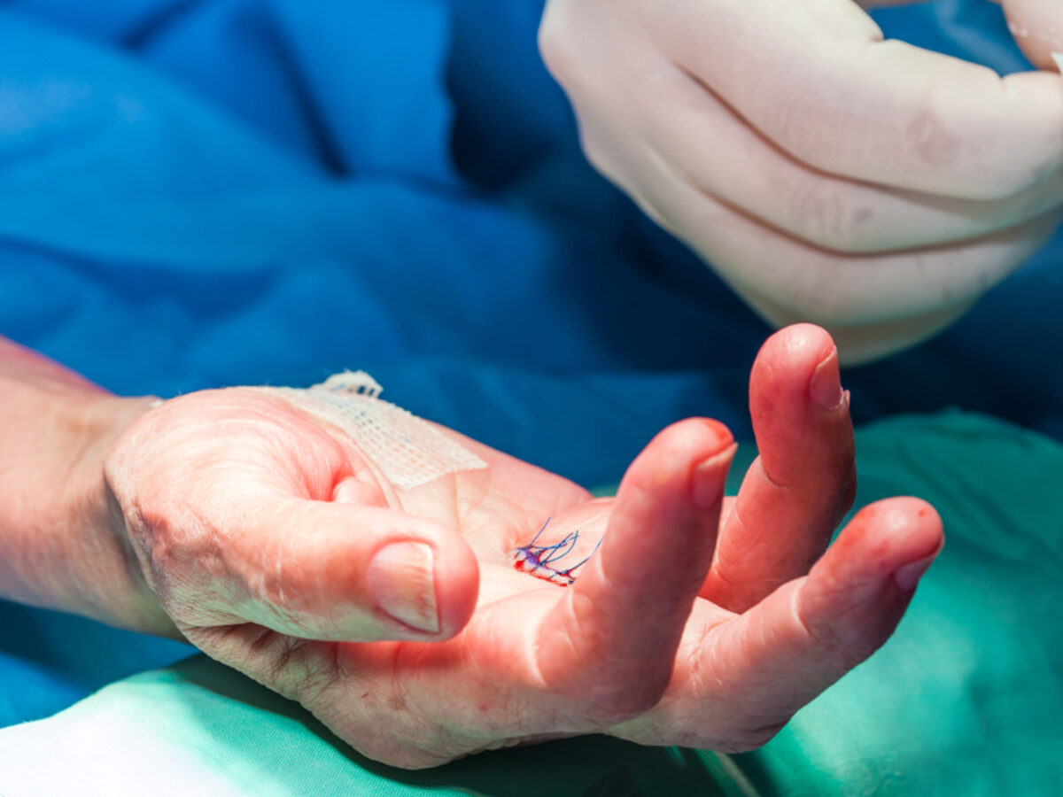 体験する手外科 = ORTHOPLASTIC,HAND & RECONSTRU… 体験する手外科 第1巻 外傷編 | 鳥谷部荘八 |本 | 通販 | Amazon