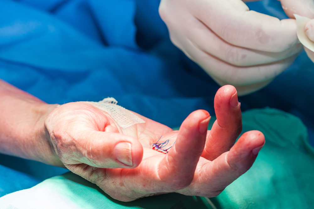 orthopedic hand surgeon performing surgery on patient