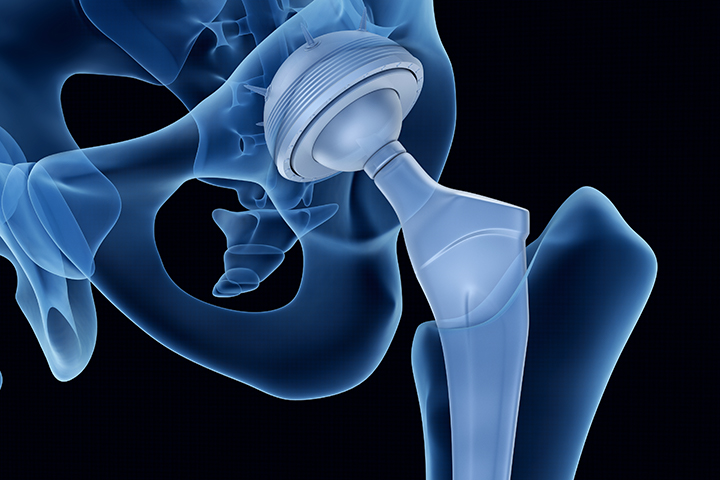 Hip Replacement at Iowa Ortho